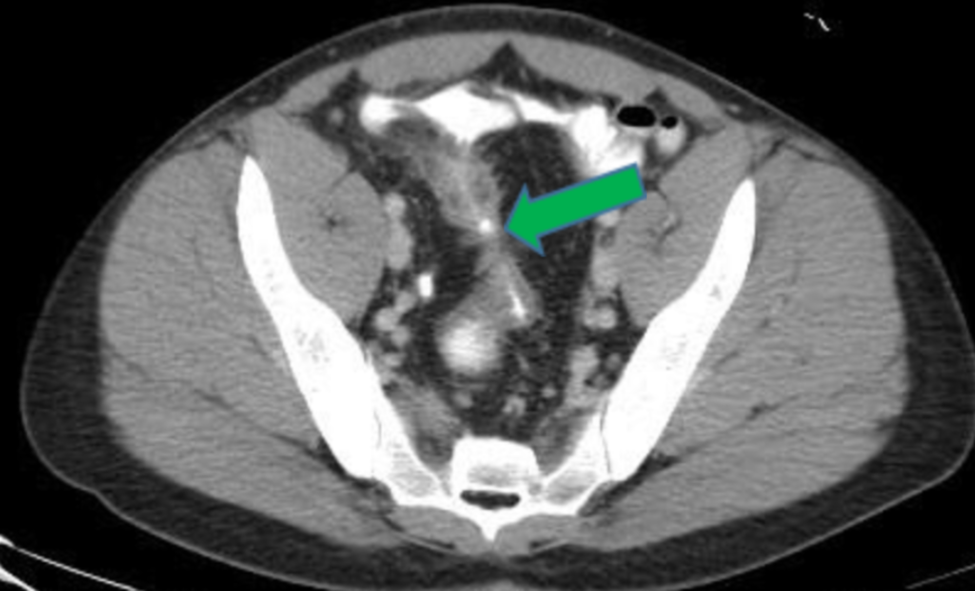 Cureus Recurrent Urinary Tract Infection in a Patient With