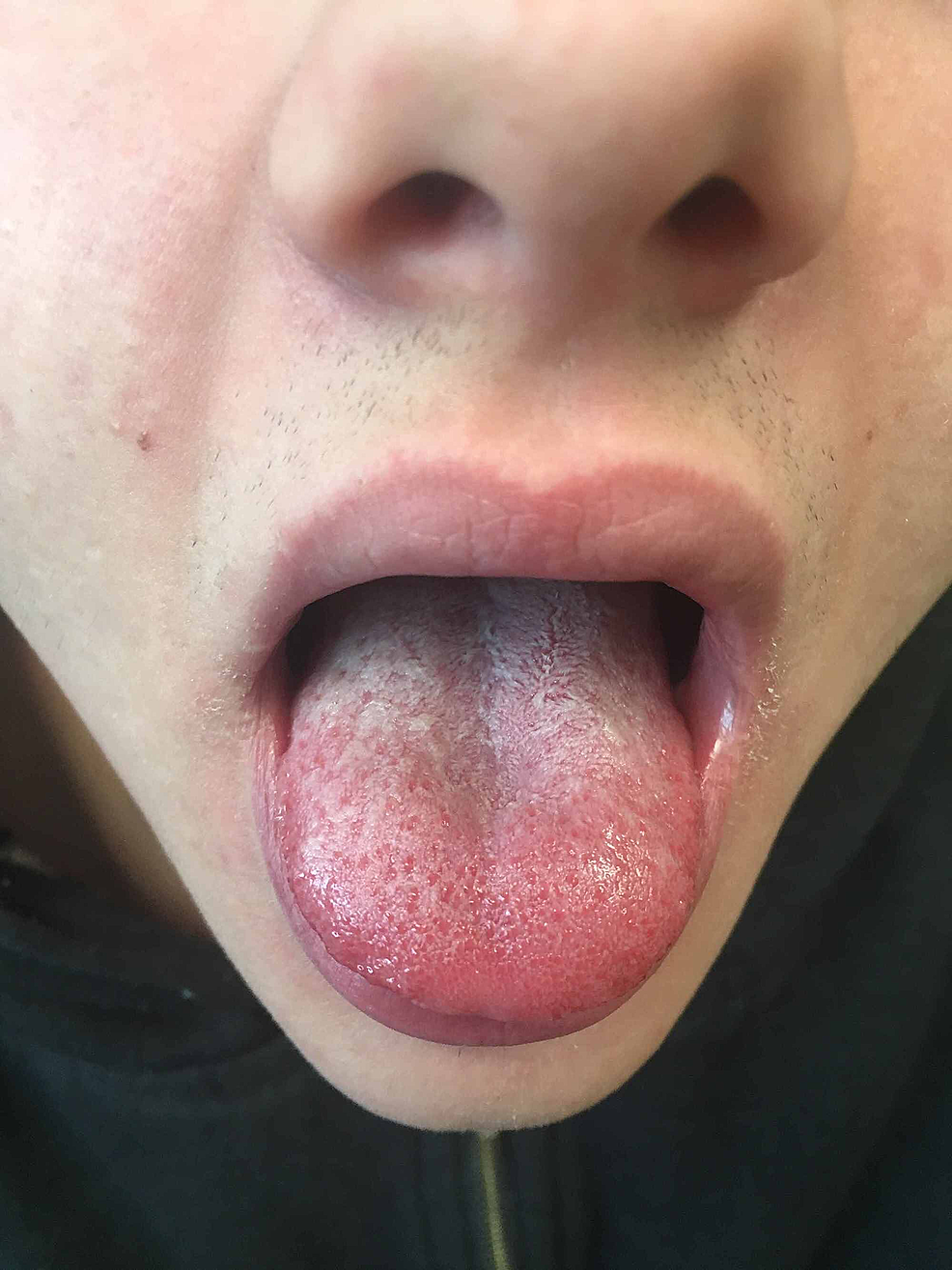 Cureus, Atypical Presentation of Scarlet Fever