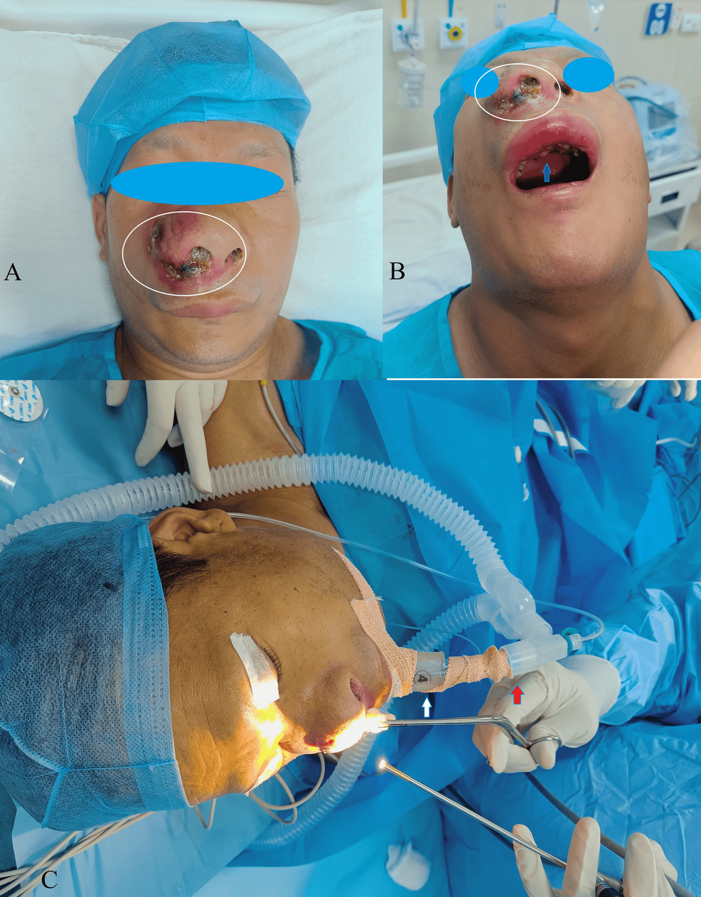 Orotracheal Intubation Challenges in an Anticipated Difficult Mask  Ventilation, Preoxygenation, Tricky Laryngoscopy, and Supraglottic Airway  Device Insertion: A Case Report | Cureus, image size:986x1262