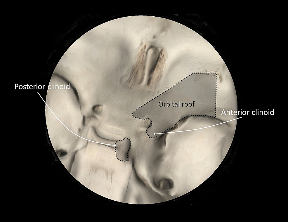 Cureus | Transcavernous Approach to the Basilar Apex: A Cadaveric ...