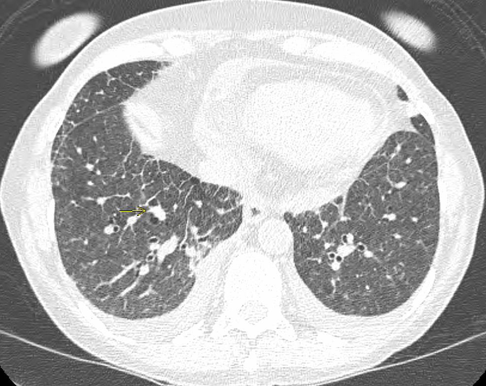 Multifactorial Pulmonary Hypertension in Systemic Sclerosis Cureus
