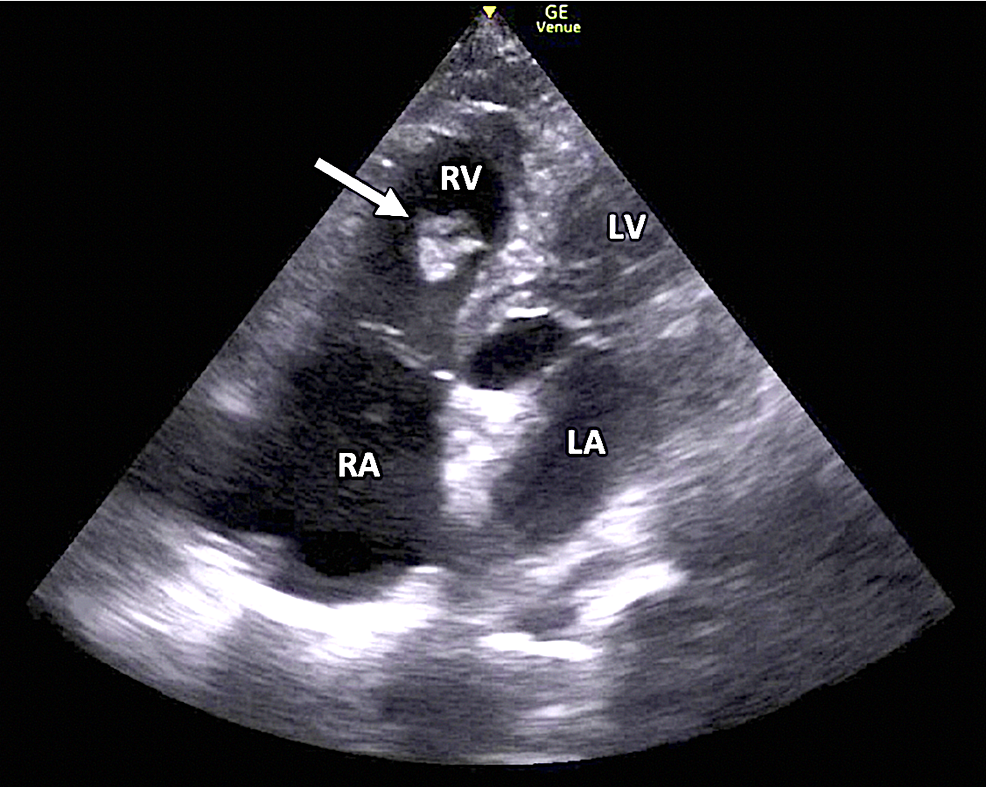 cureus-right-heart-thrombus-in-transit-diagnosed-with-focused-cardiac