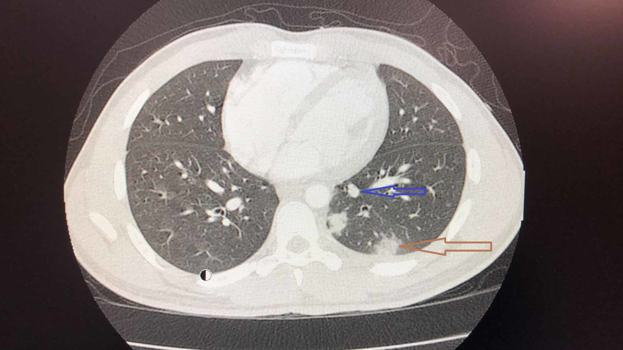 Cureus | Severe Acute Respiratory Syndrome Coronavirus 2 (SARS-CoV-2 ...