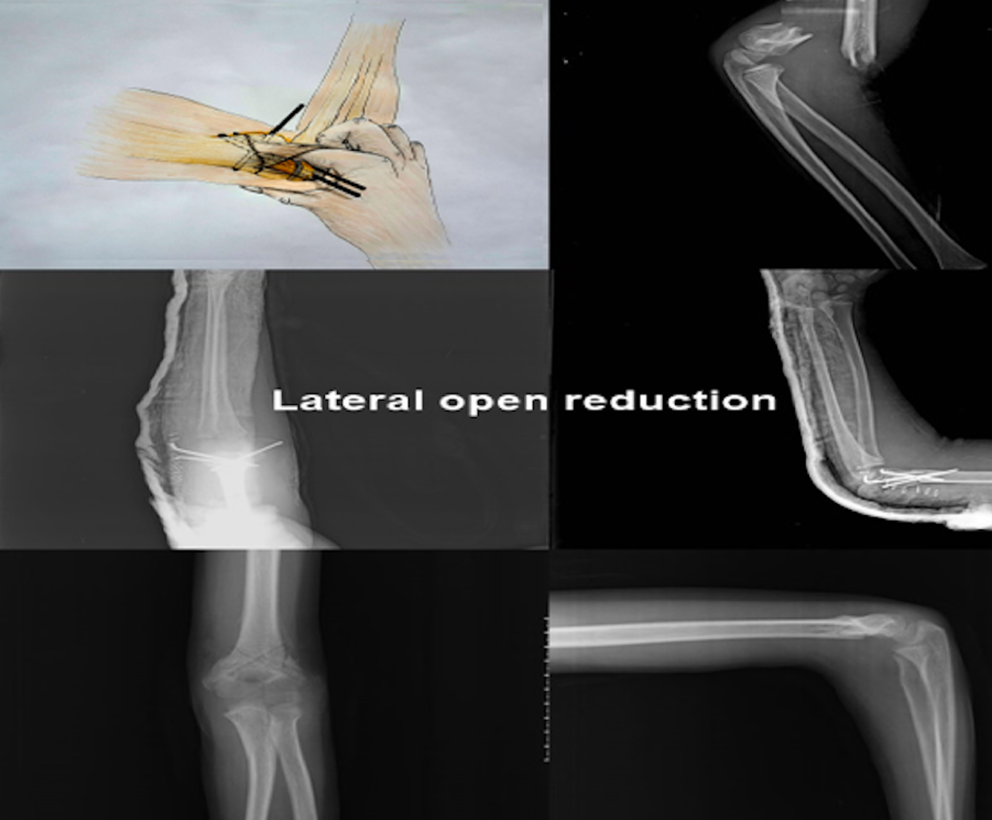 supracondylar fracture peidatric orthopedic surgeon vs