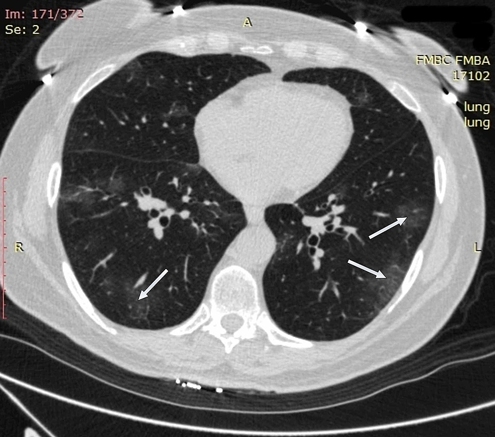 potilaan 2 rintakehän CT-kuvantaminen sisäänotossa