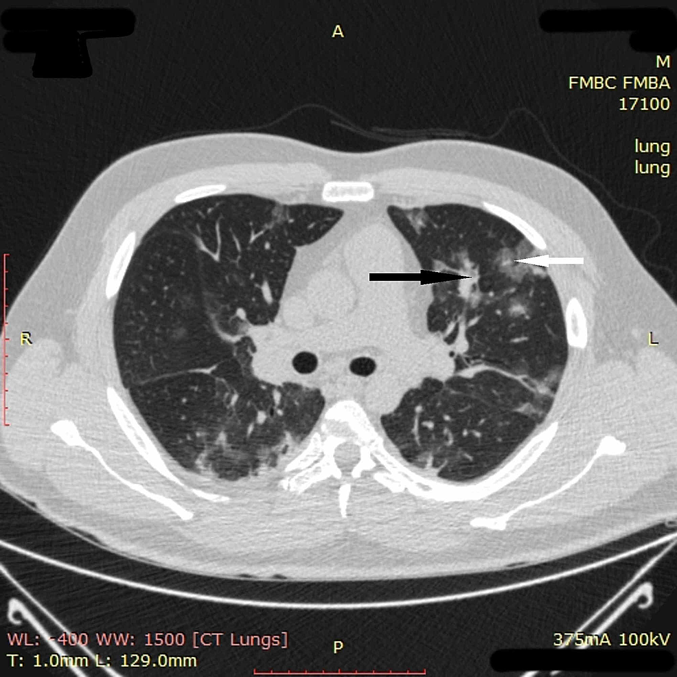 potilaan 3 rintakehän CT-kuvantaminen sisäänotossa