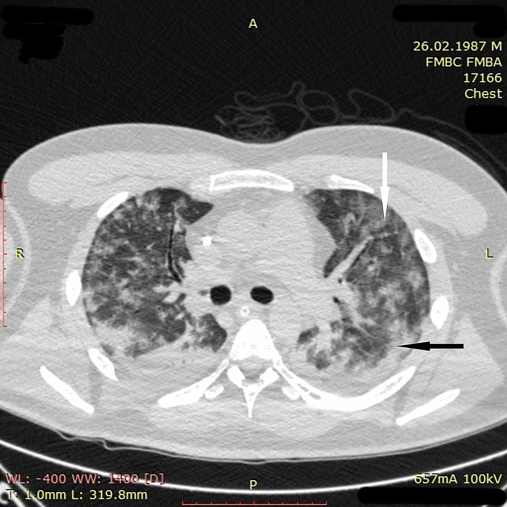 potilaan rintakehän CT-kuvantaminen-3-on-day-four