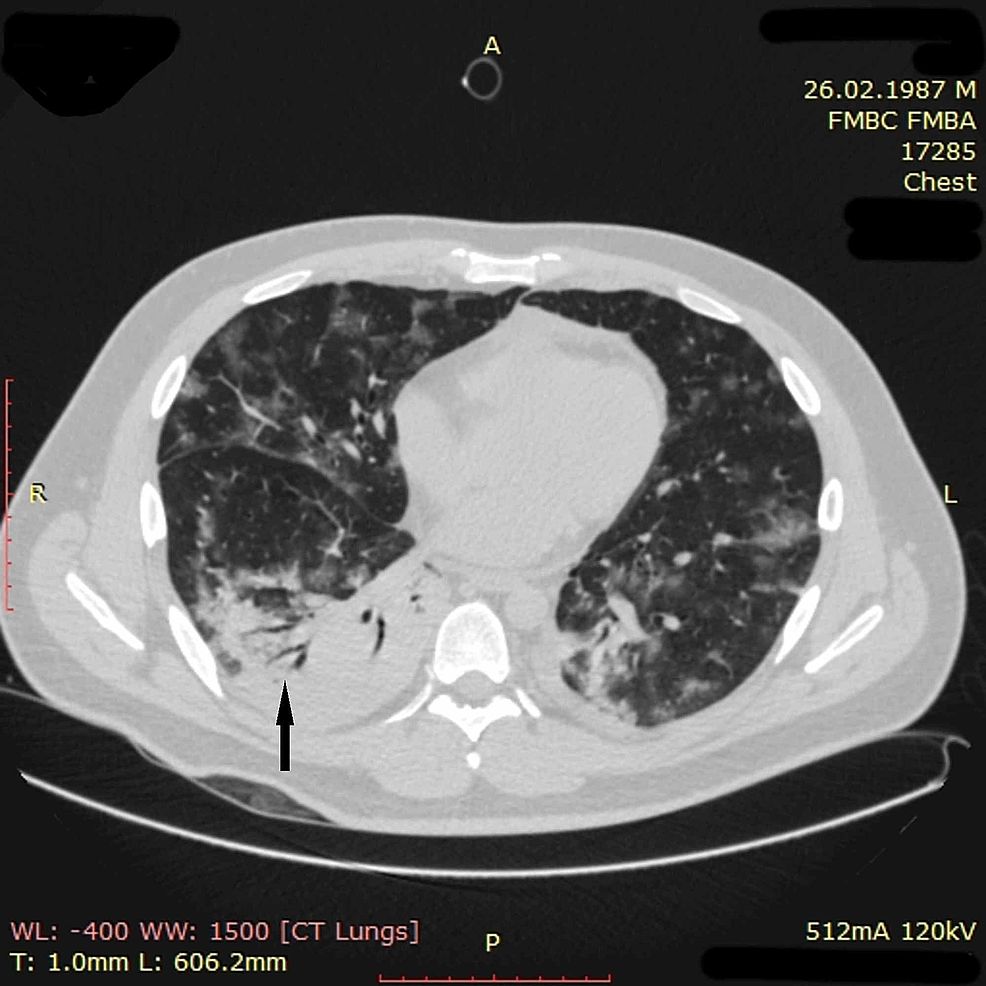 potilaan rintakehän CT-imaging-of-patient-3-on-day-nine
