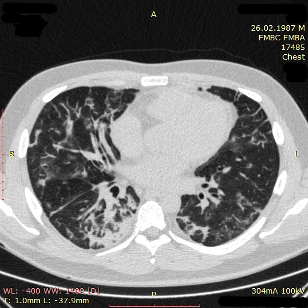 potilaan rintakehän CT-kuvantaminen 3-päivänä-23