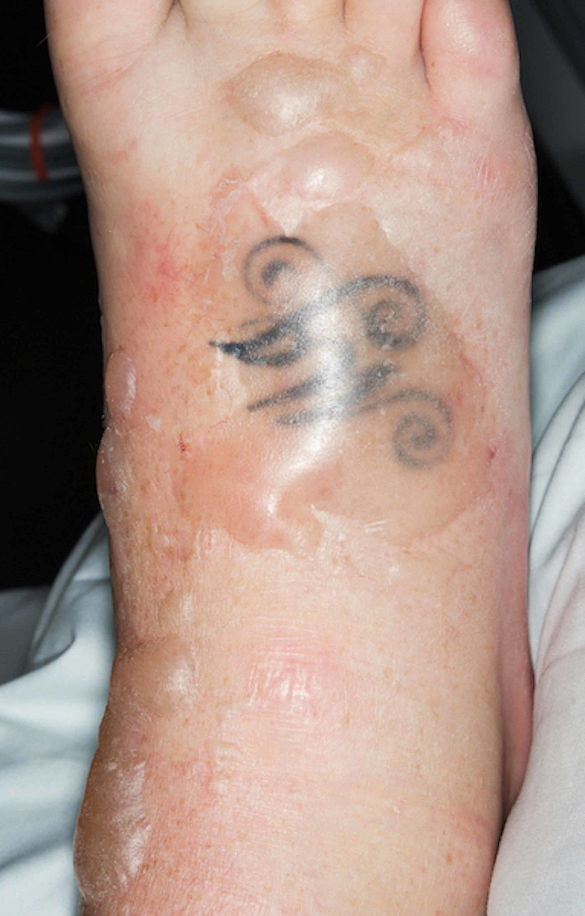 Solar Freckles LongTerm Photochromic Tattoos for Intradermal Ultraviolet  Radiometry  ACS Nano