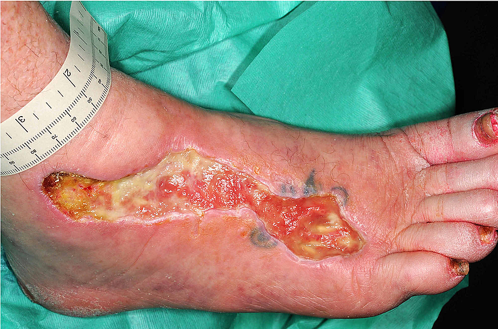 Foot-ulceration-after-larval-therapy-and-surgical-debridement.