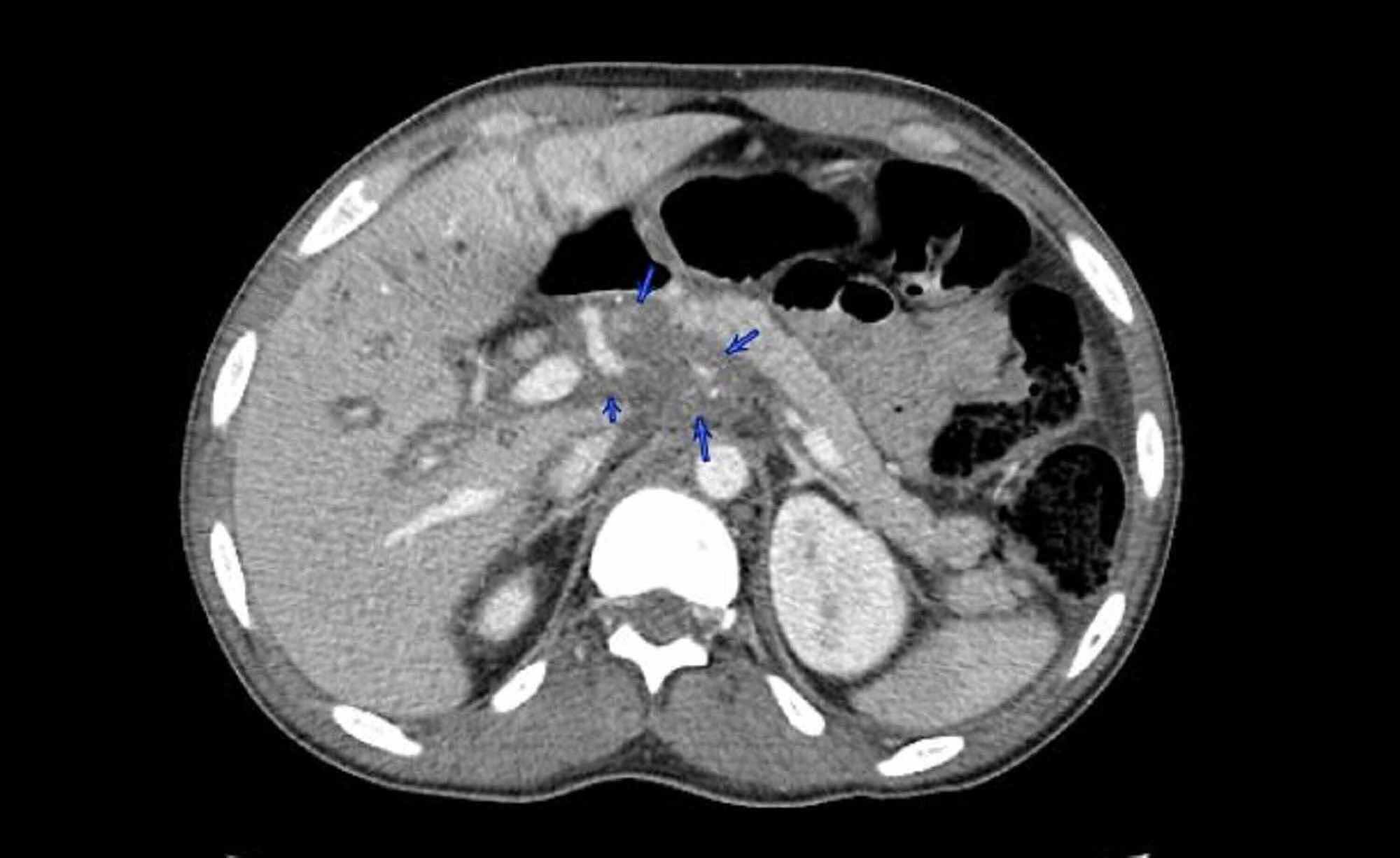 Cureus An Presentation of Extrahepatic Cholestasis due to