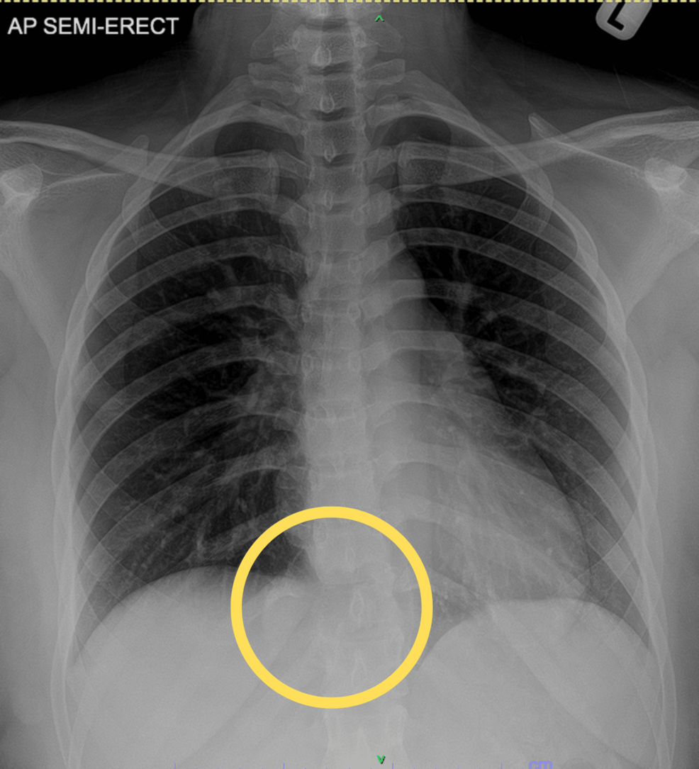 Giant Cell Tumour of the Spine | Cureus, image size:986x1085