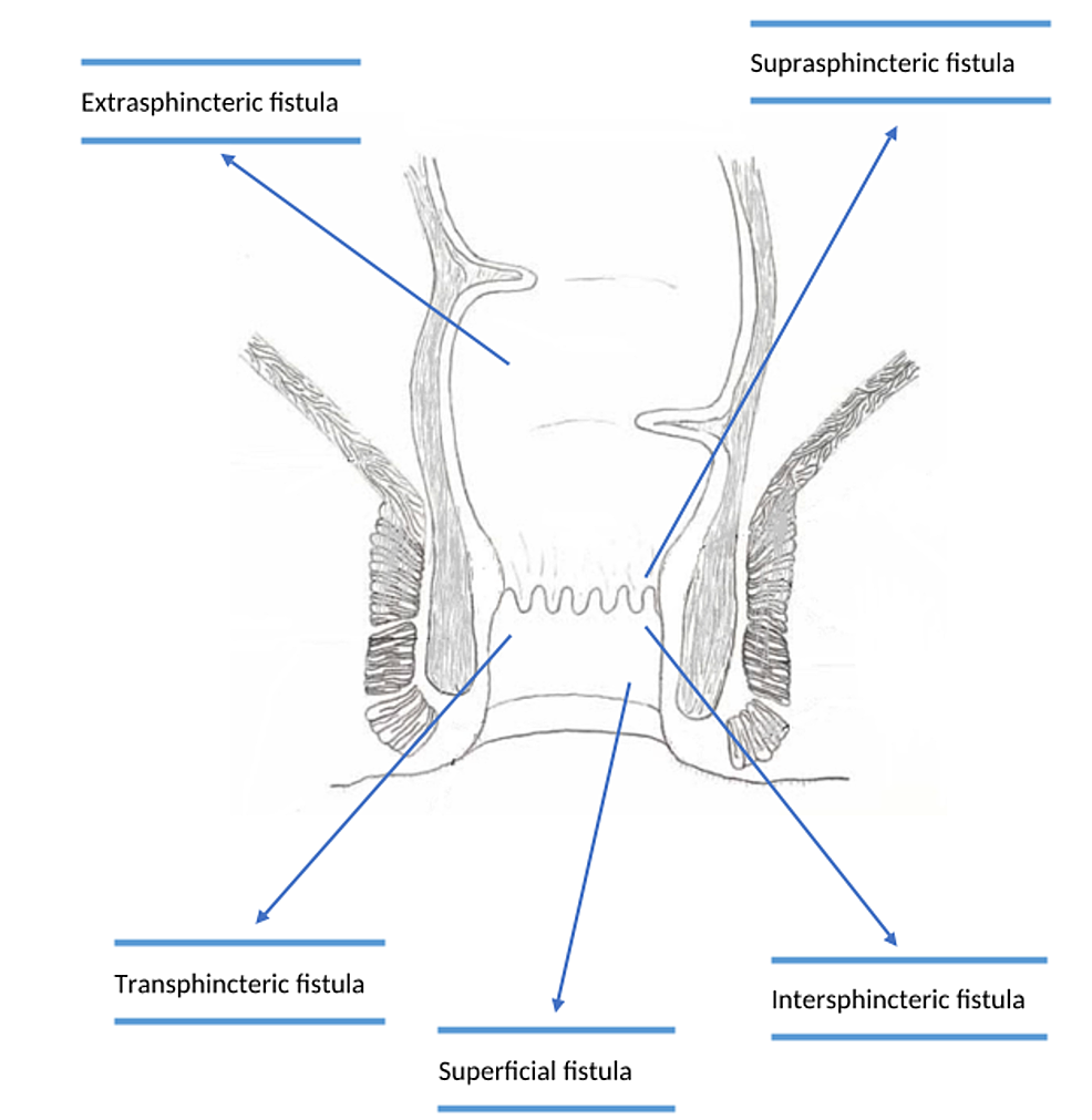 Classification-of-peri-anal-fistula