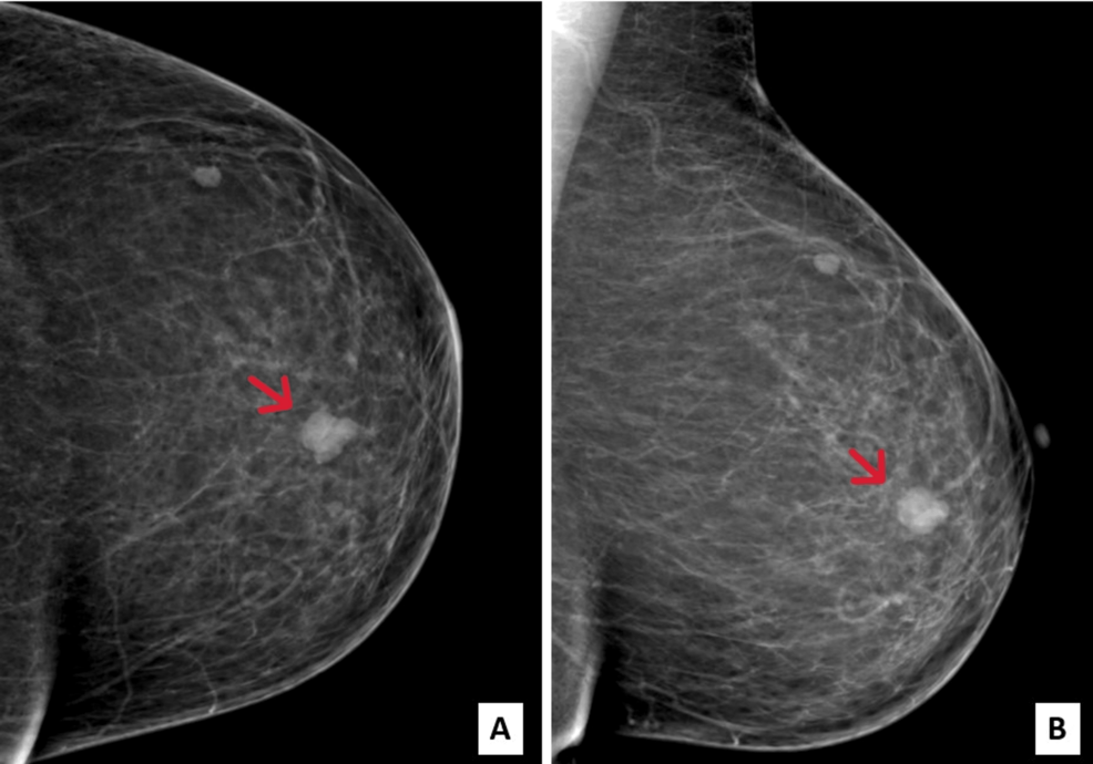 Secretory Breast Carcinoma: A Rare Breast Cancer With an Excellent 