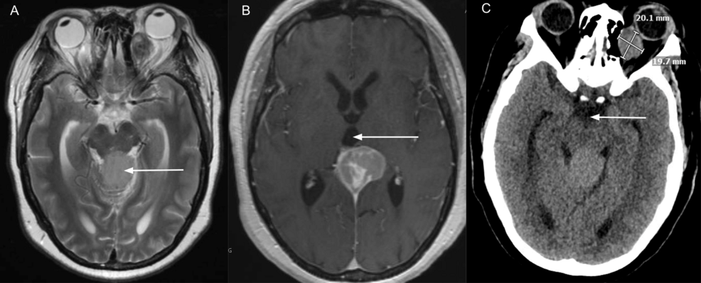 Preoperative-MRI-and-CT-images-depicting-the-pineal-mass-and-mass-effect-on-surrounding-tissues.