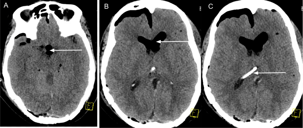 Postoperative-computerized-non-contrast-tomography-of-the-head-demonstrating-tension-pneumocephalus-involving-the-intraventricular-space.-