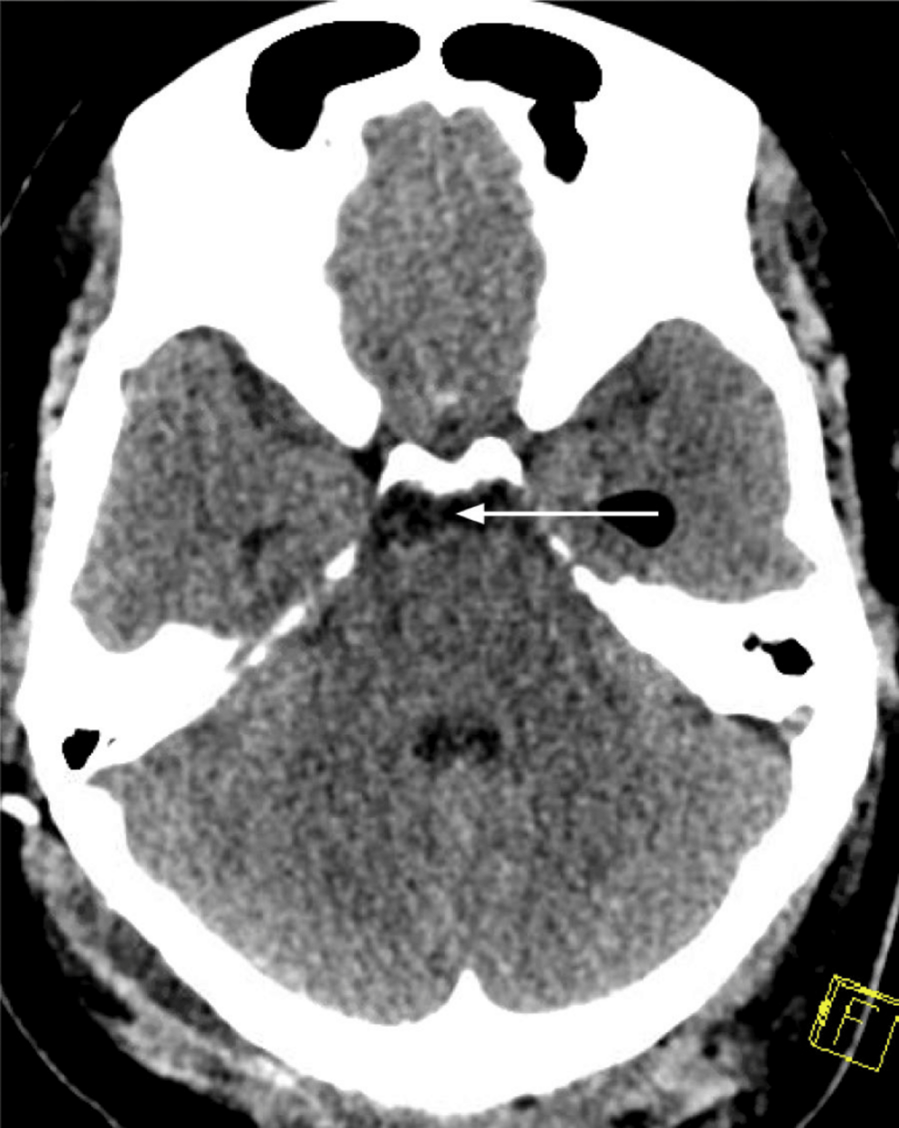 Non-contrast-tomography-of-the-head-with-resorption-of-intraventricular-pneumocephalus.