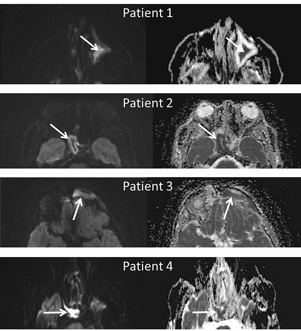 diffusion-weighted-mri-for-stroke