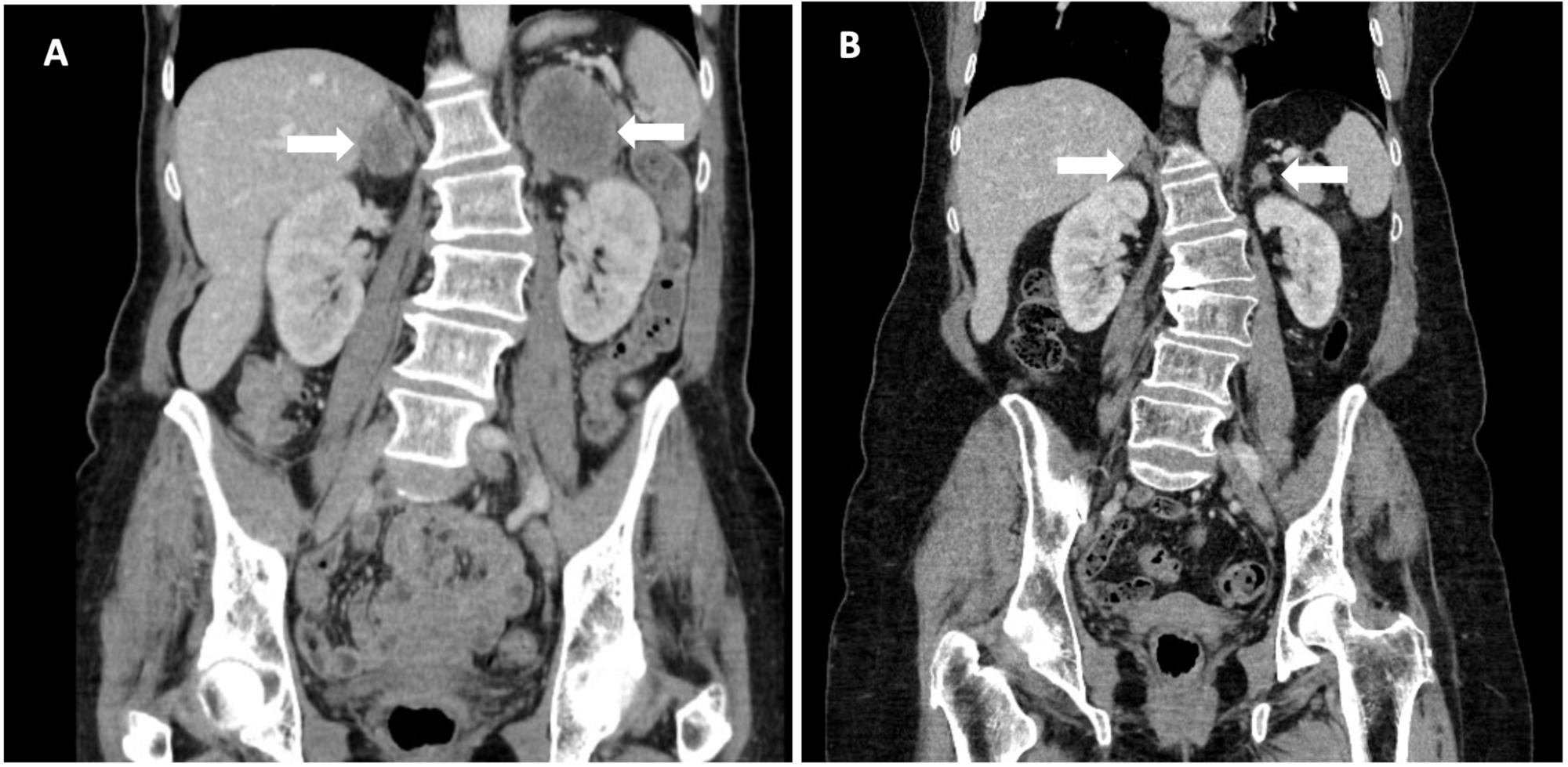 Cureus Immunotherapy Benefit in a Patient With NonSmall Cell Lung Cancer and a Rare BRAF Mutation