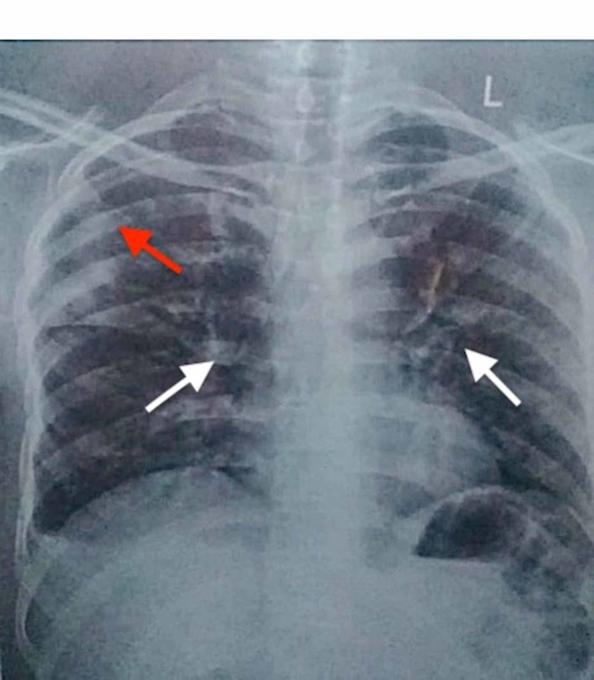 Cureus COVID19 Pneumonia An Emerging Cause of Syndrome of