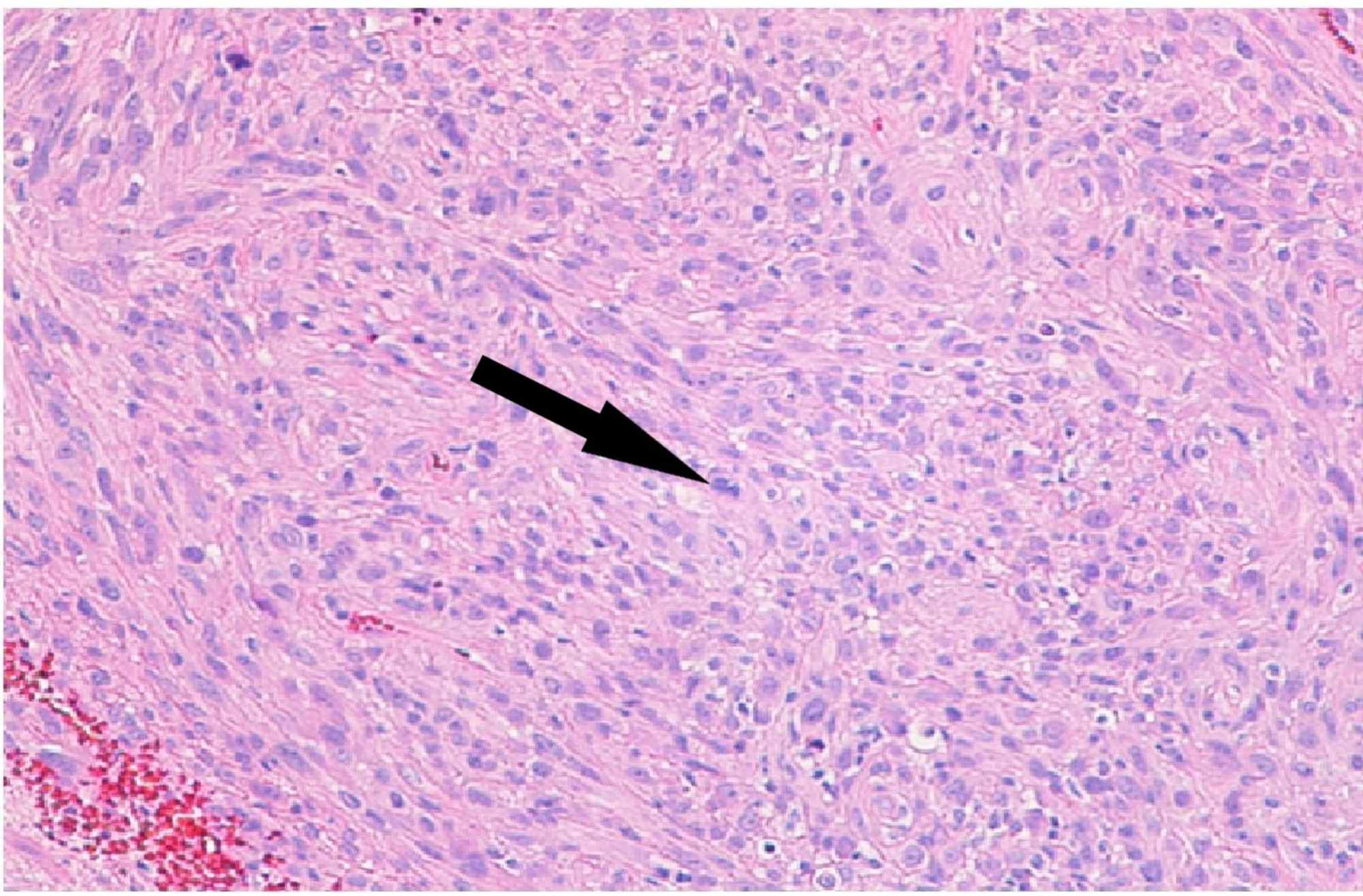 Cureus Malignant Epithelioid Neoplasm of the Brain