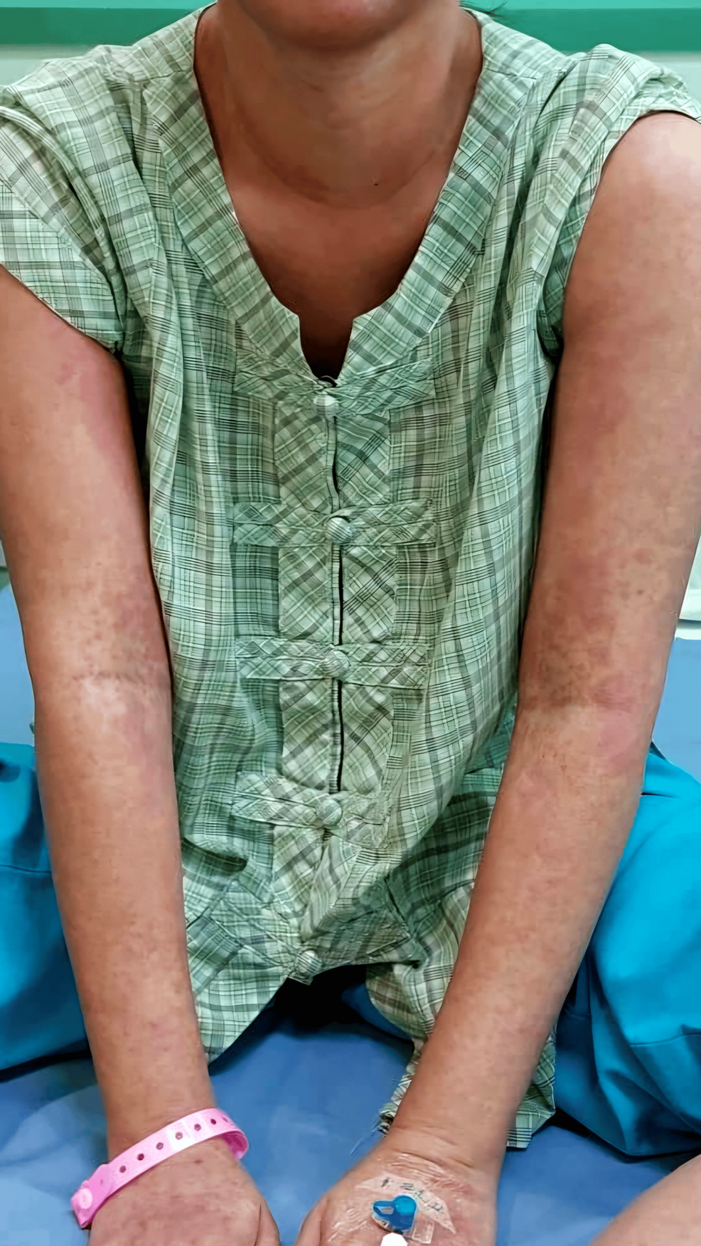 Atypical Presentation of Drug Reaction With Eosinophilia and Systemic Symptoms (DRESS) Syndrome: When Gastrointestinal Symptoms Obscure the Diagnosis | Cureus Atypical Presentation of Drug Reaction With Eosinophilia and Systemic Symptoms (DRESS) Syndrome: When Gastrointestinal Symptoms Obscure the Diagnosis | Cureus