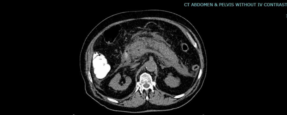 semaglutide pancreatitis legal team in kentucky Semaglutide-Induced Acute Pancreatitis Leading to Death After Four Years of  Use