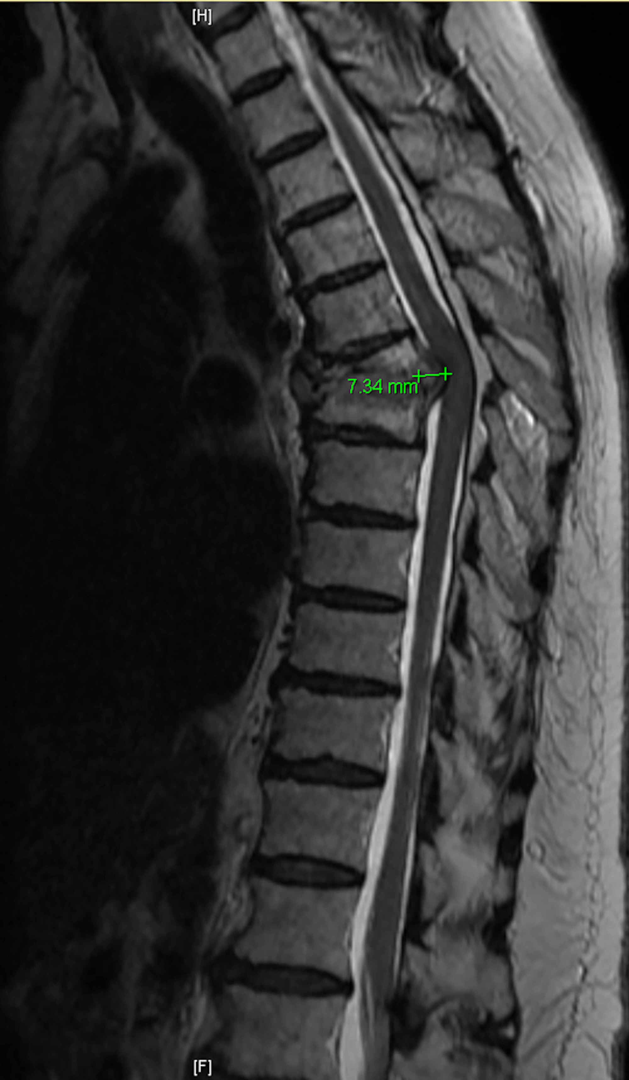 Cureus A Rare Form of Pott’s Disease With Multifaceted Pathological