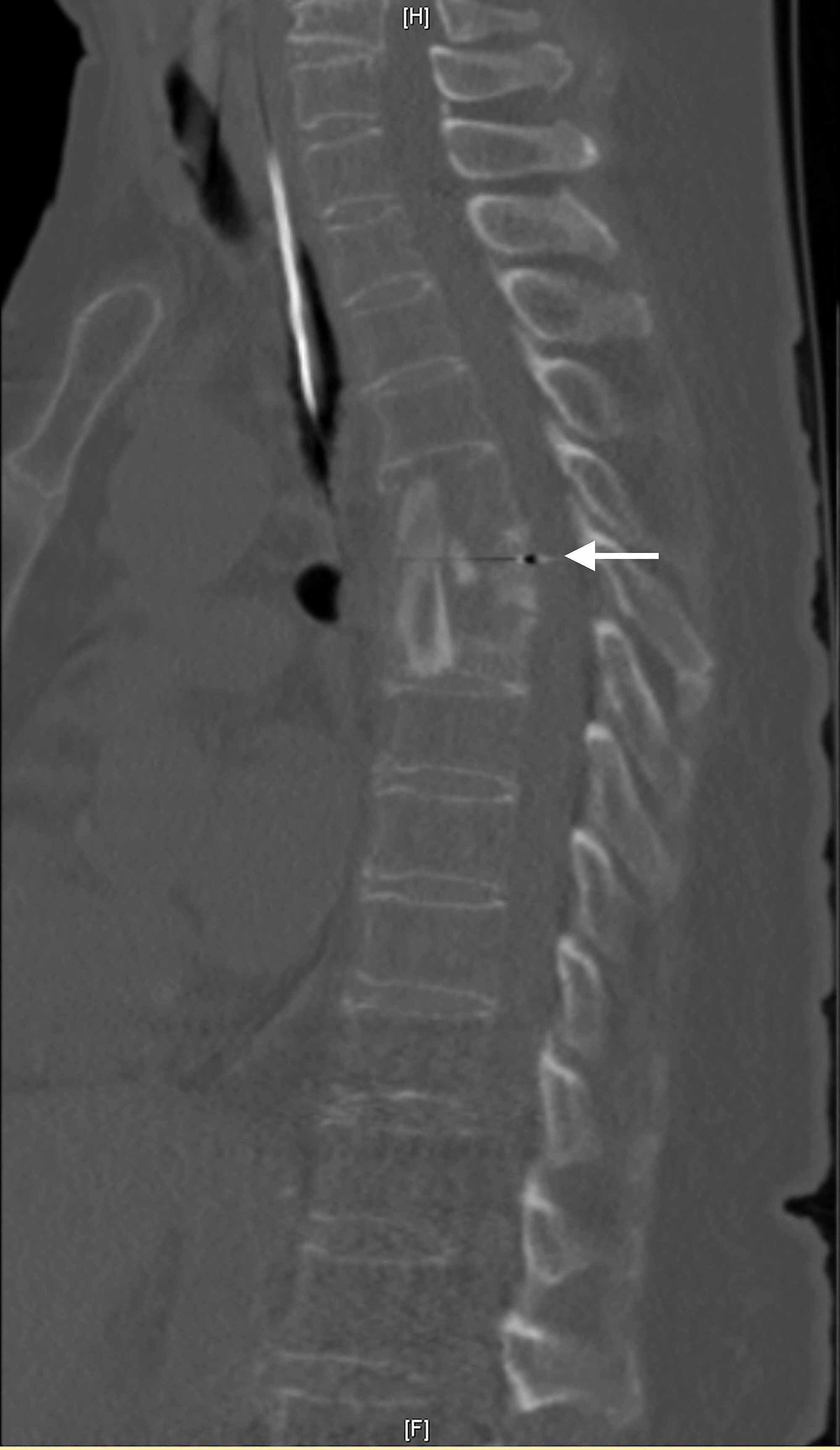 Cureus A Rare Form of Pott’s Disease With Multifaceted Pathological