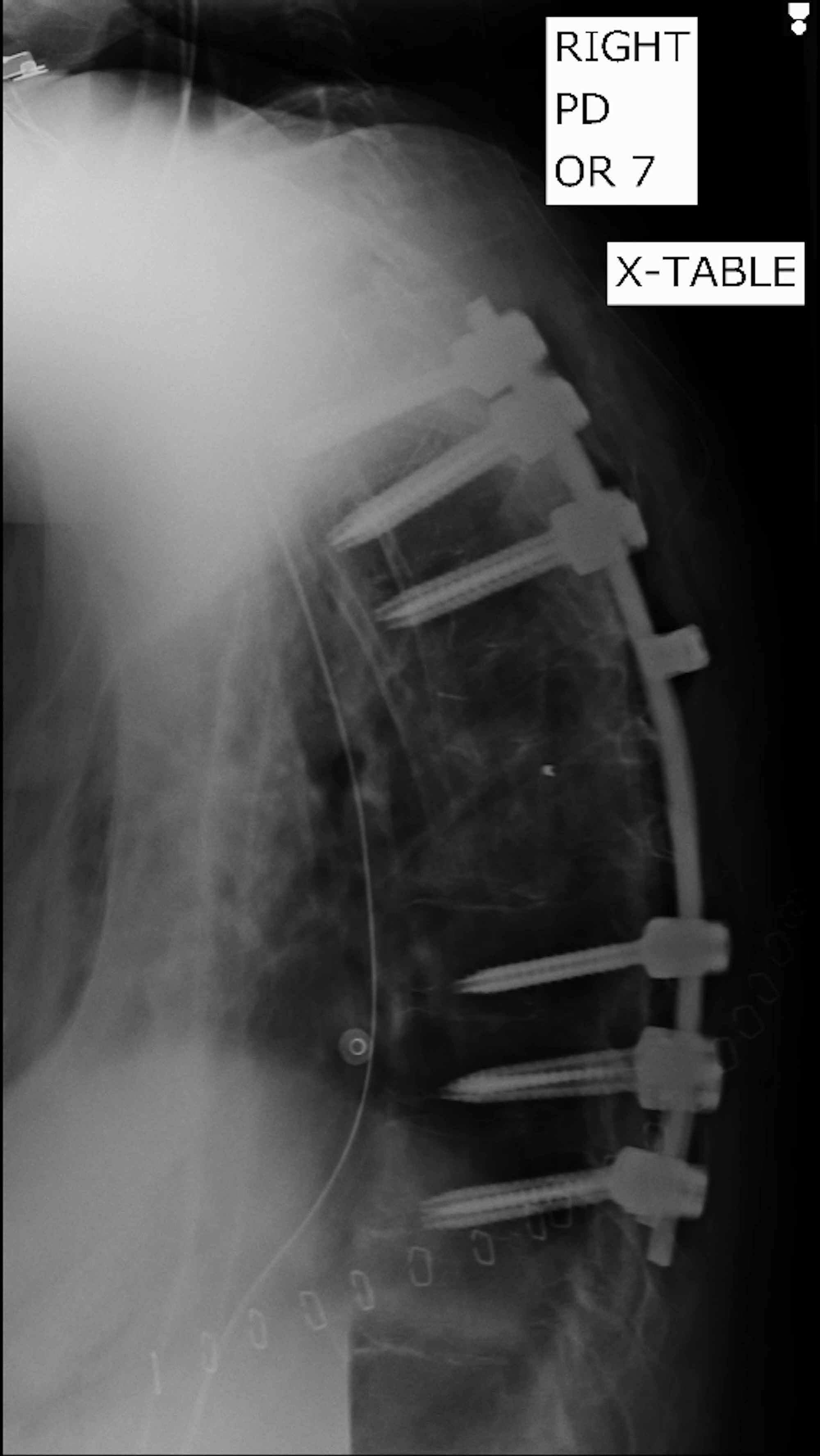 Cureus A Rare Form of Pott’s Disease With Multifaceted Pathological