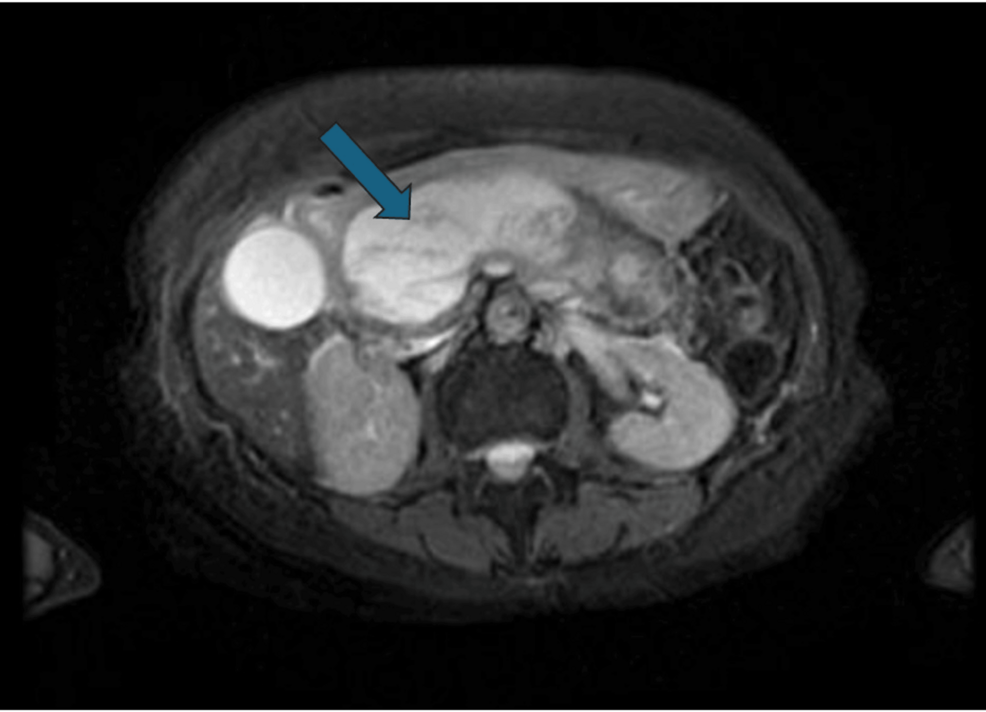 Walled-off-fluid-collection-in-the-pancreas.