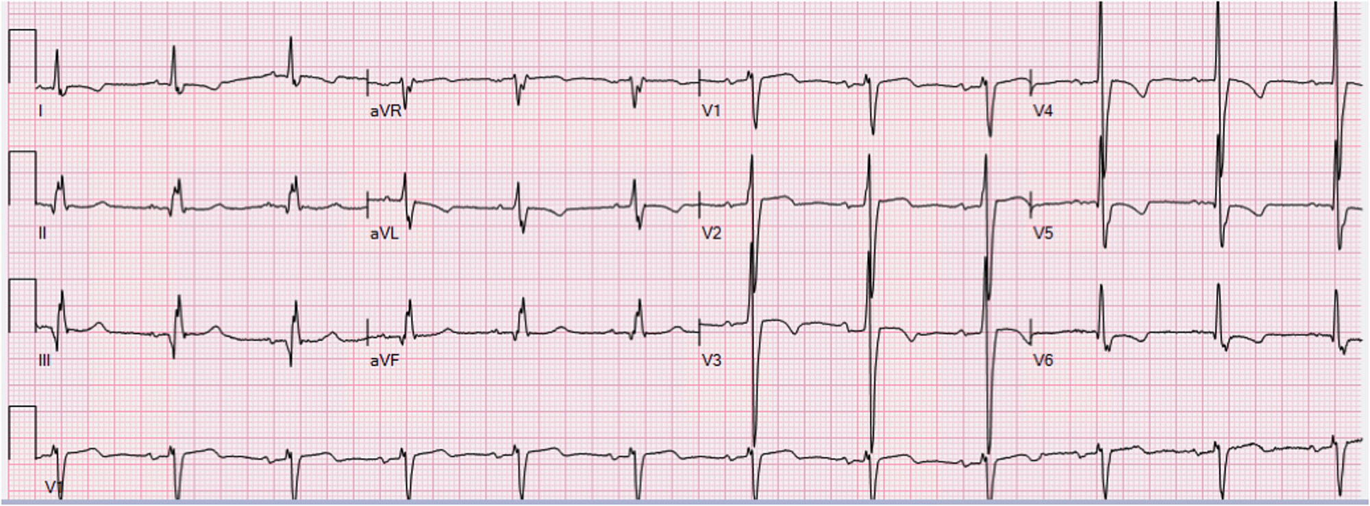 Cureus | Rupturing Abdominal Aneurysm Presenting as Acute Coronary Syndrome