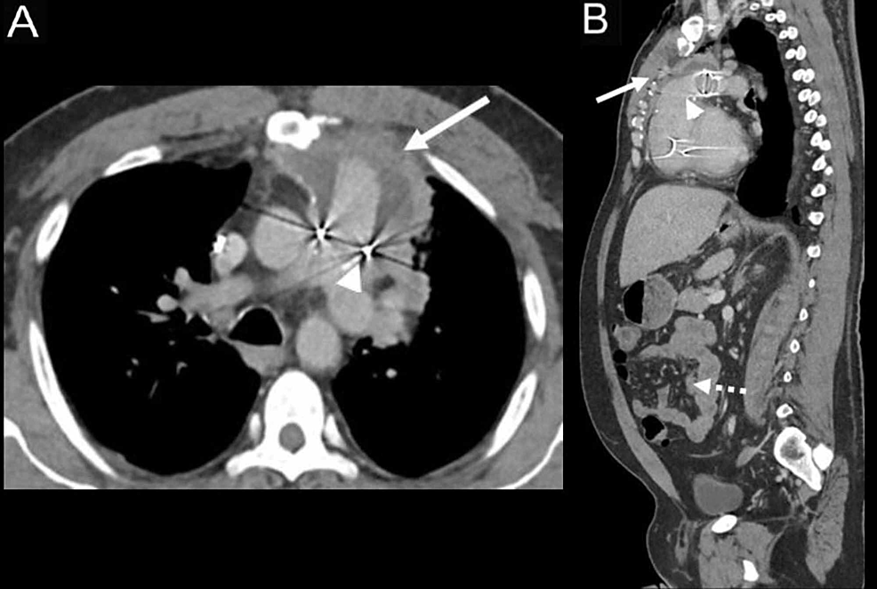 Nontyphoidal Salmonella As A Cause Of Mediastinal Abscess In A Patient 