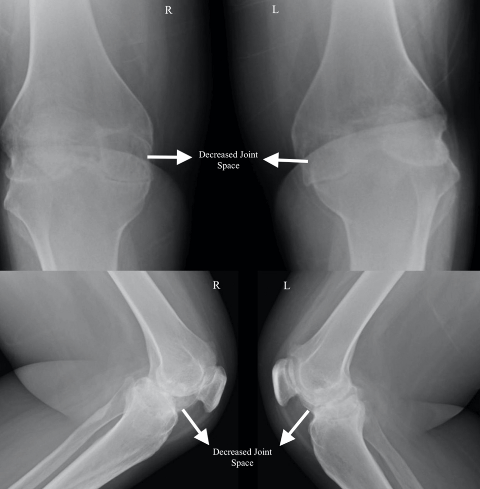 Anteroposterior-and-lateral-X-rays-showing-severe-osteoarthritis-of-both-knees-with-decreased-joint-space