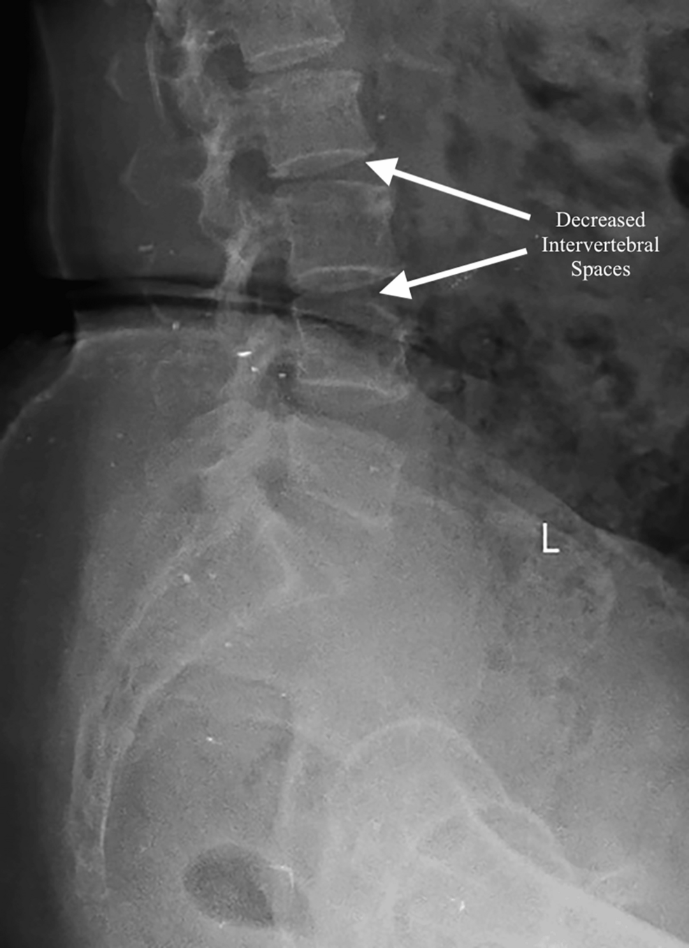 Xray-of-the-lumbar-spine-showing-decreased-intervertebral-spaces