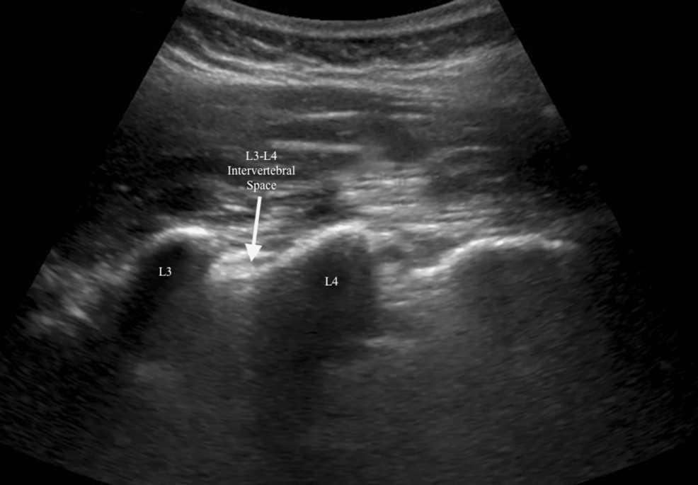 Ultrasound-image-showing-L3-L4-intervertebral-space