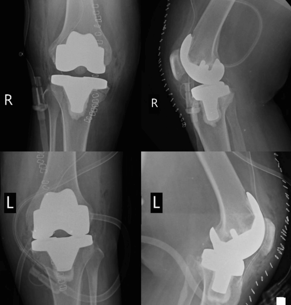 Postoperative-X-ray-of-both-knees-showing-implants