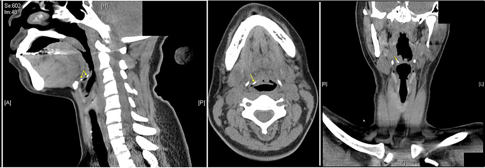 CT-panel-demonstrating-the-fish-bone-right-vallecula-(arrows).