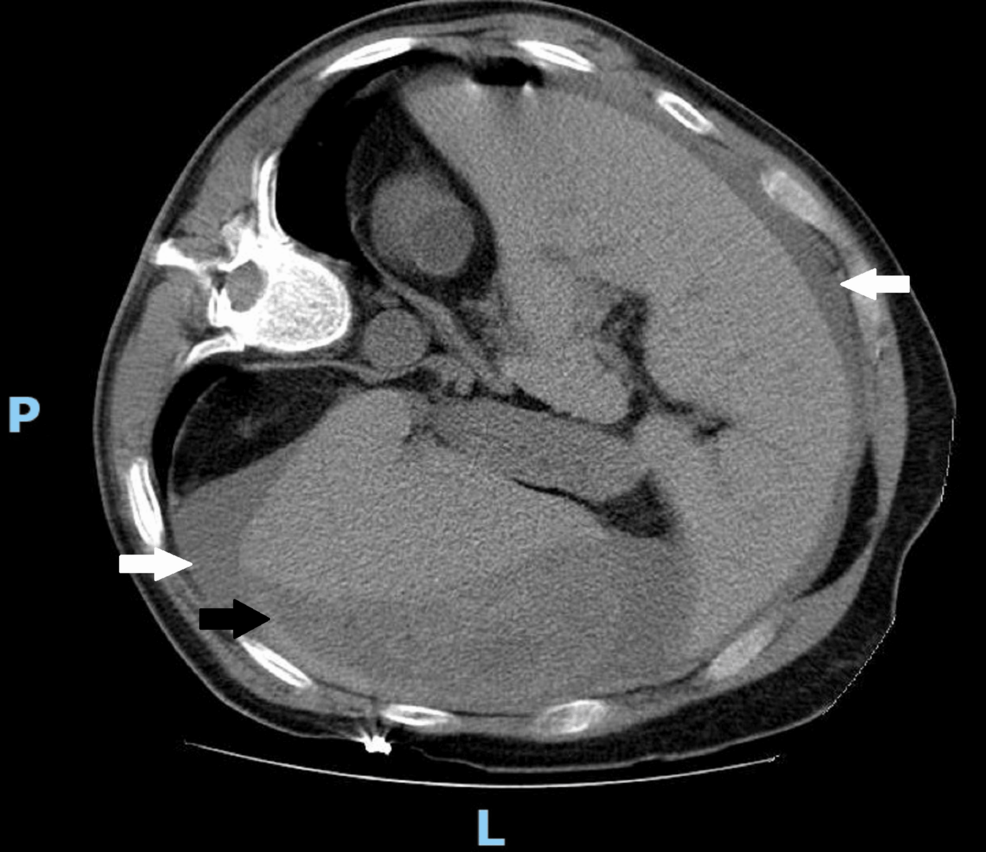 Abdominal-computed-tomography-showing-large-hemoperitoneum-(white-arrows)-and-splenic-subcapsular-hematoma-(black-arrow)