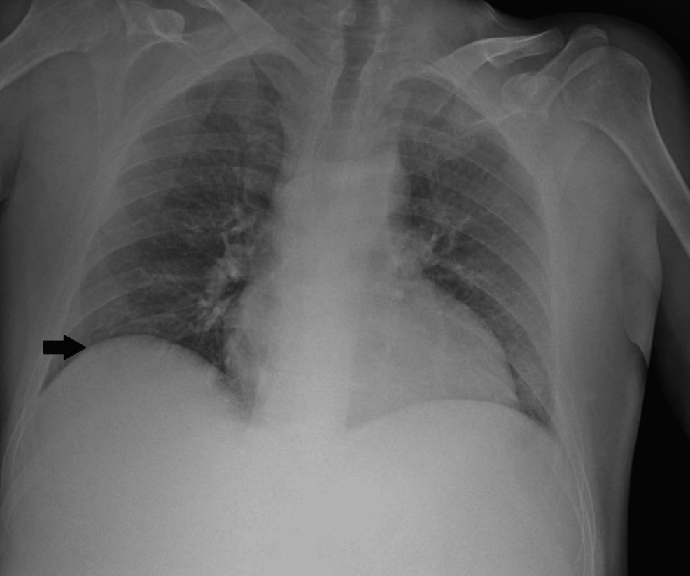 Chest-X-ray-with-a-slight-elevation-of-the-right-hemidiaphragm-(black-arrow)-and-an-enlarged-cardiothoracic-ratio