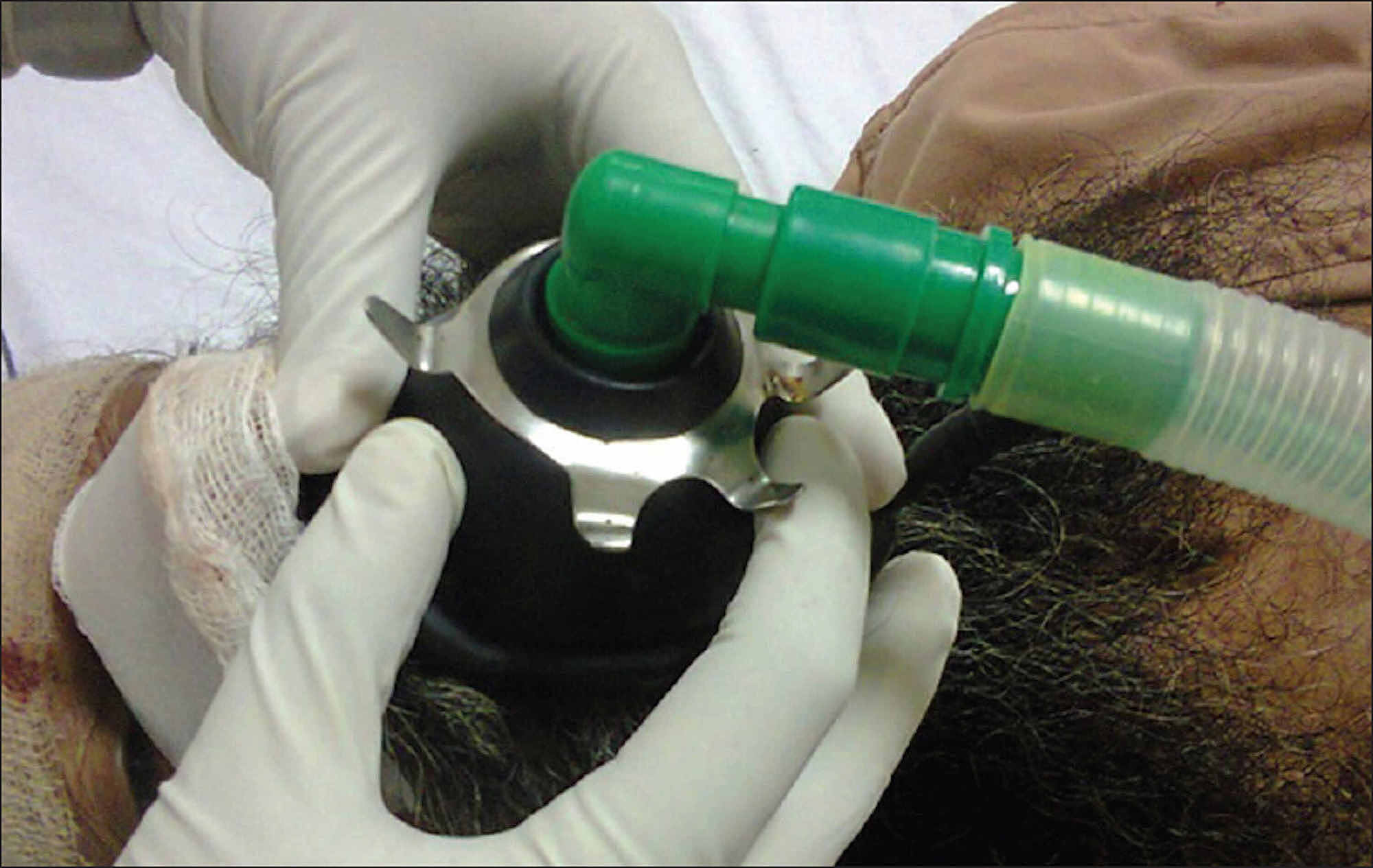 Cureus Induction of General Anesthesia and Mask Ventilation With a