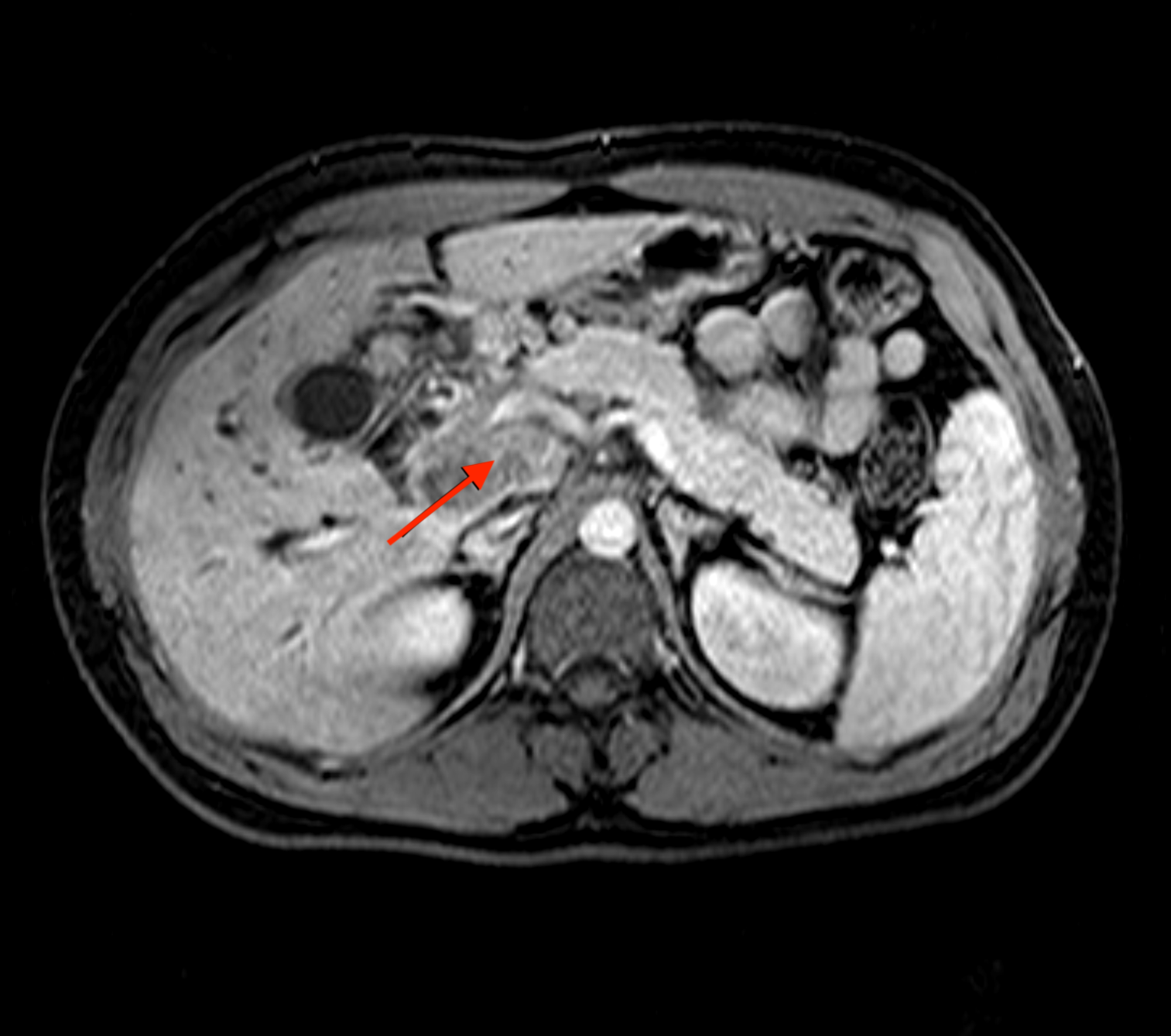 Cureus | A Rare Case of Pancreatic Tuberculosis Diagnosed via ...