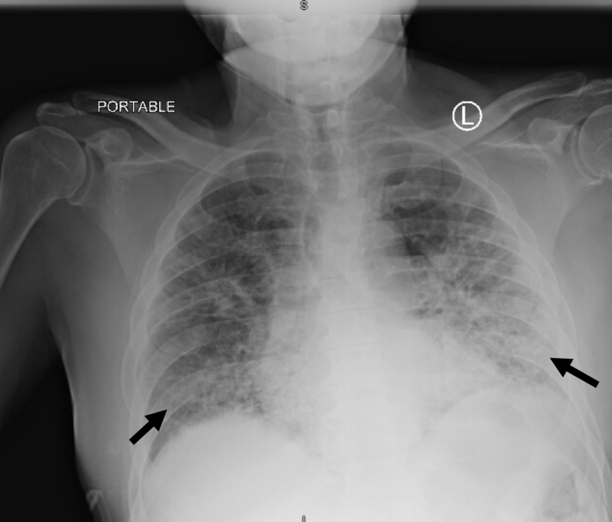 Cureus Fatal in a KidneyPancreas Transplant Recipient With