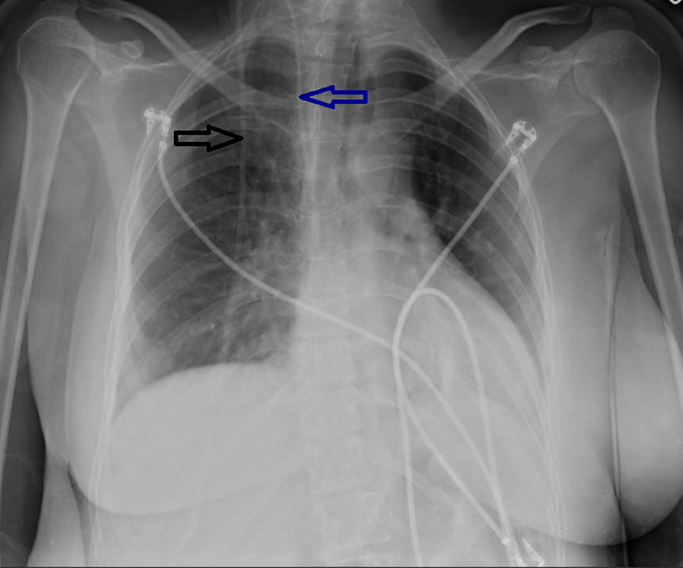 How Does A Vp Ventriculoperitoneal Shunt Work Fort