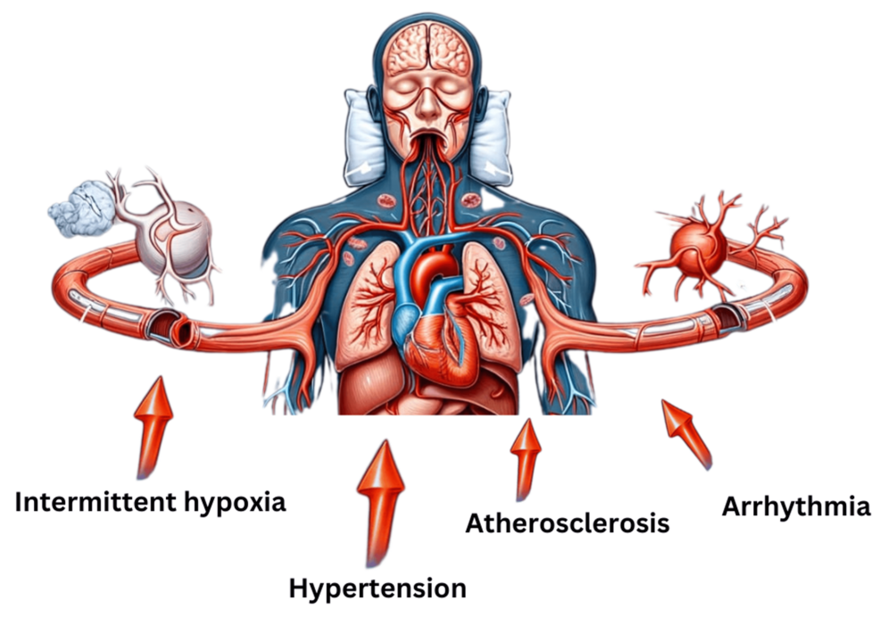 Sleep apnea symptoms force patients to exert increased respiratory effort, leading to intrathoracic pressure fluctuations that may adversely affect cardiovascular function