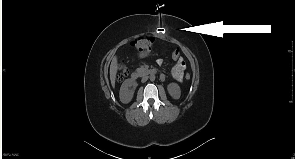 Early Buried Bumper Syndrome A Rare Complication of Percutaneous