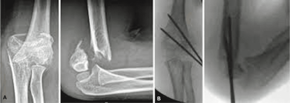 【コーウィン様用】NERVE / Fracture Loss of Fixation of a Type IV Supracondylar Humerus Fracture