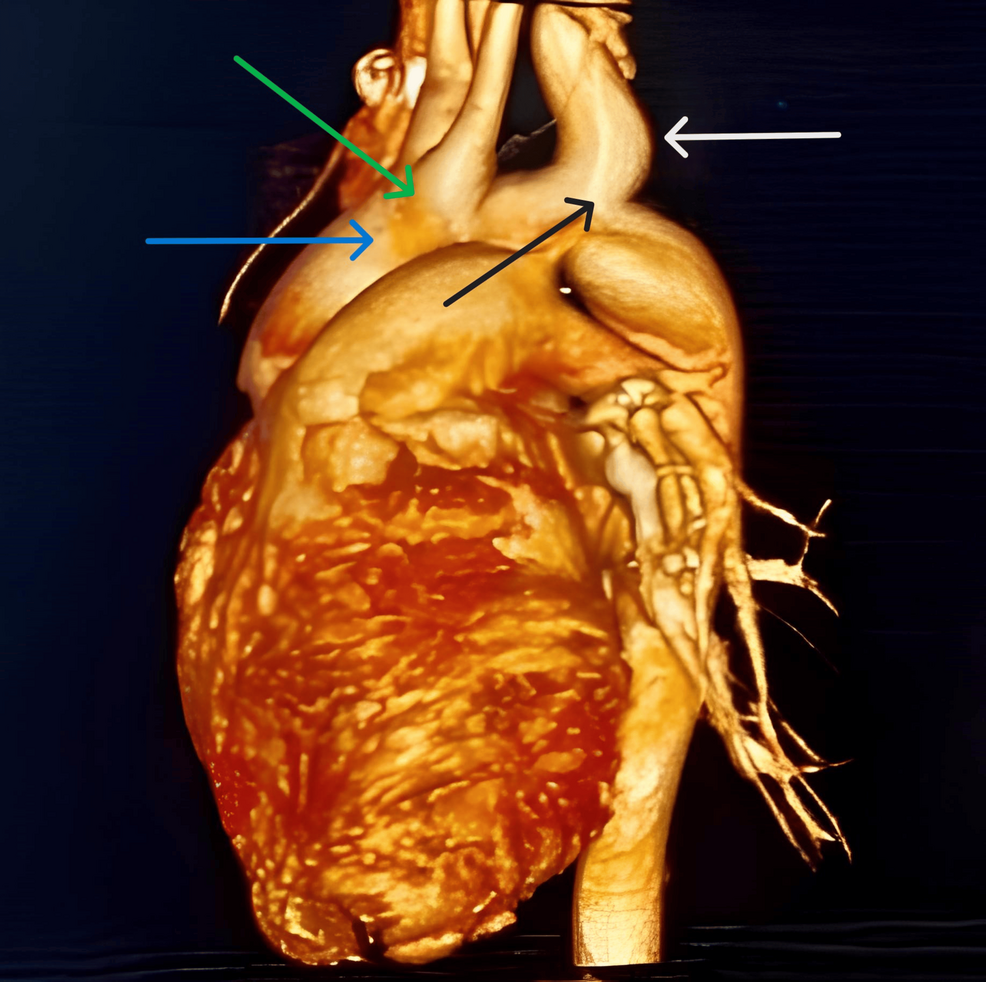 Computed-tomography-(CT)-aortogram-showing-arch-of-aorta-(blue-arrow),-common-origin-of-right-brachiocephalic-and-left-common-carotid-artery-(green-arrow),-aneurysmal-dilatation-of-left-subclavian-artery-(white-arrow),-coarctation-of-aorta-(black-arrow).