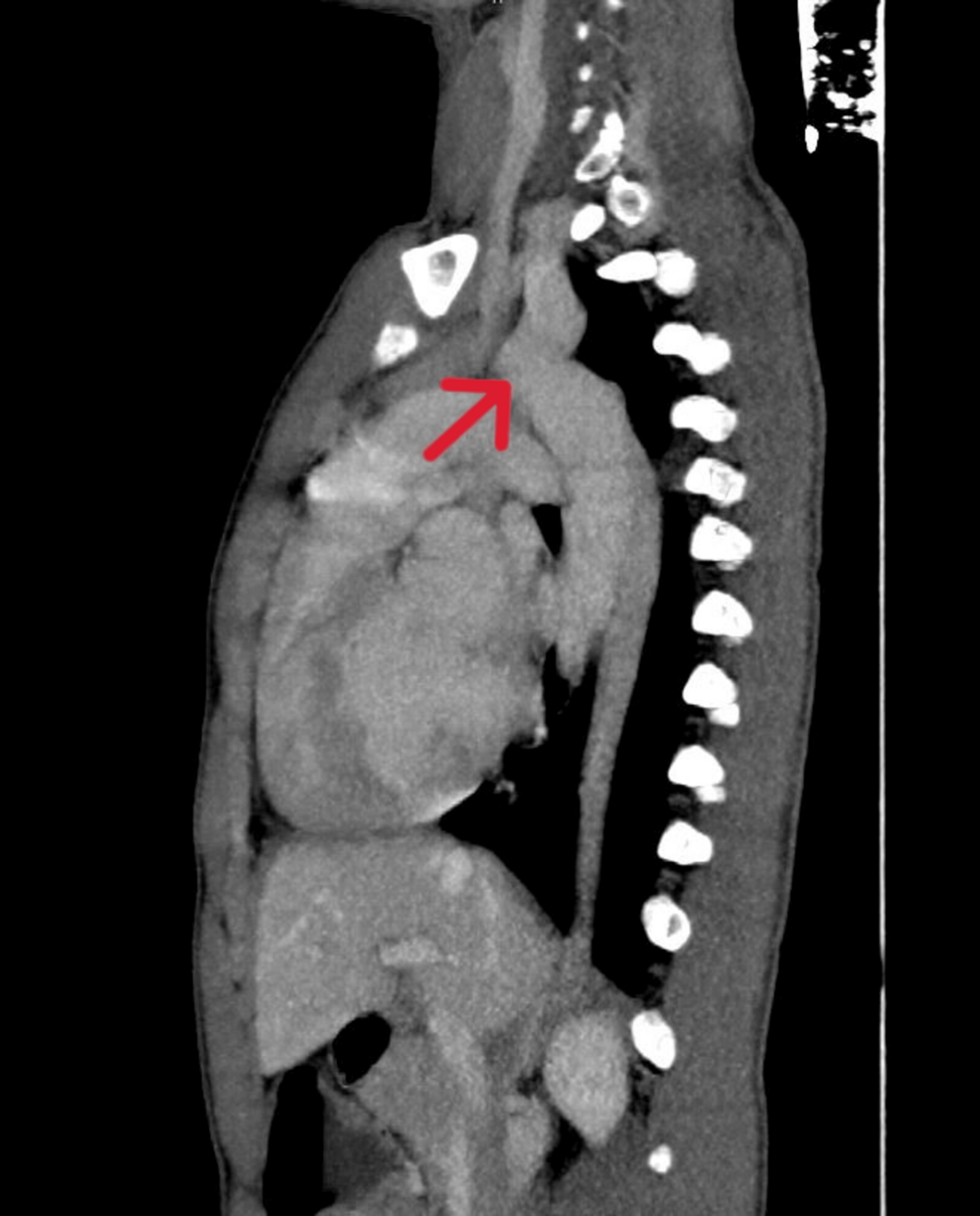 Computed-tomography-of-chest-showing-the-coarctation-of-aorta-(red-arrow).